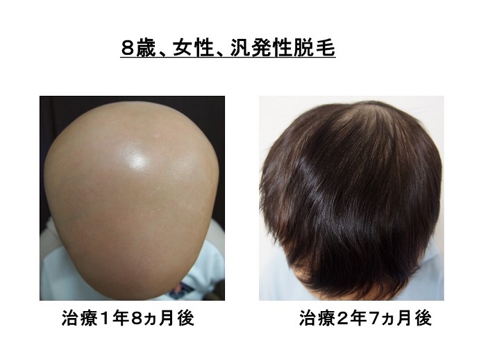 円形脱毛症　病院